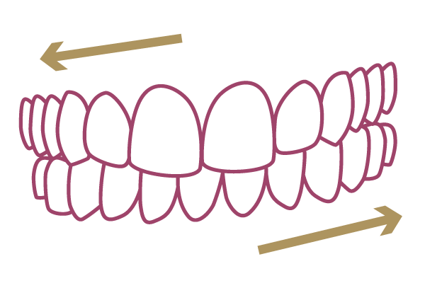 歯の歪み